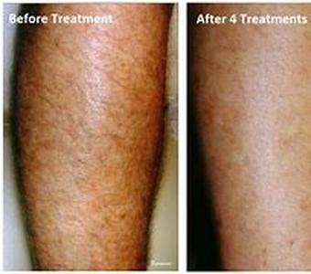 Laser Hair Removal : Is It really permanent