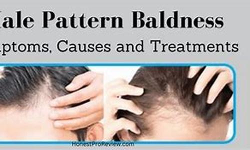 Male Hair Loss: Natural Hair Loss Treatment