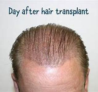 Who Needs A Hair Transplant