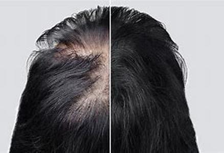 Hair Loss, Not The End Of The World