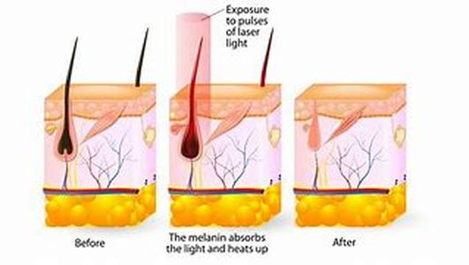 Understanding Laser Hair Removal