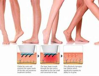 The Cons of Laser Hair Removal