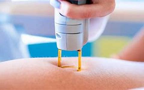 Seven things about Laser Hair Removal