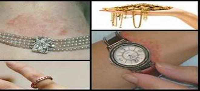 Allergies To Jewelry