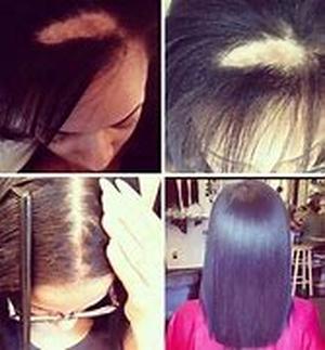 Information on Traction Alopecia