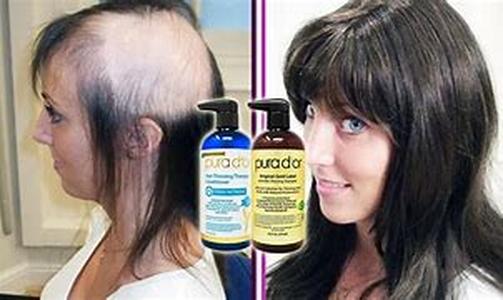 Hair Loss Shampoo: A Cheaper Solution to Your Dilemma