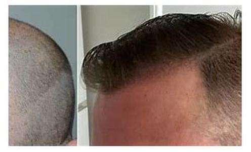 How Are Eyebrow Hair Transplant Procedures Different