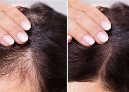 Hair Loss Myths