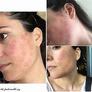 Necessary Care after Laser Hair Removal