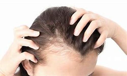 Female Hair Loss
