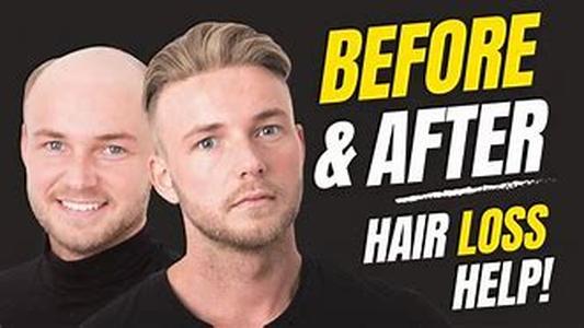 What Are Hair Replacement Systems