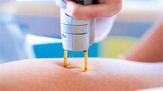 Hair Removal Options:  Thermolysis, Electrolysis Or Blend