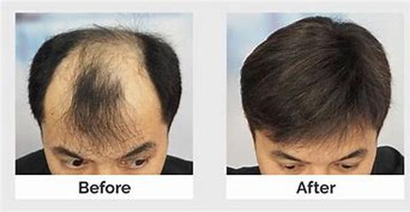 Hair Replacement  10 Things You Need To Know When Considering A Hair Replacement