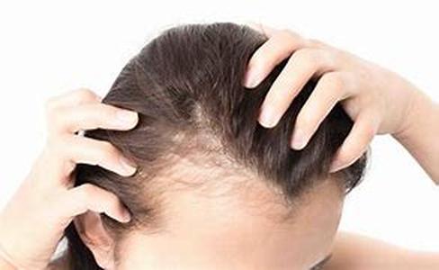 Female Hair Loss Vitamins