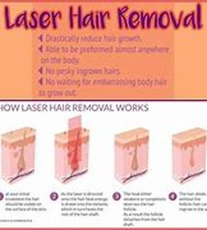 Laser hair removal - what is it
