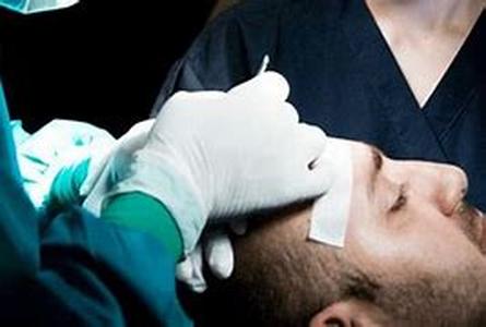 How Many Hair Transplant Grafts Do You Need