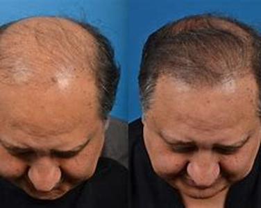 How Does Laser Hair Removal Work