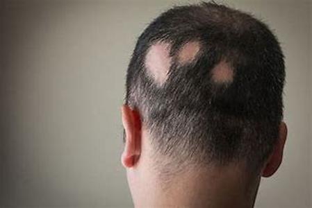 Hair Loss Caused By Lichen Planus