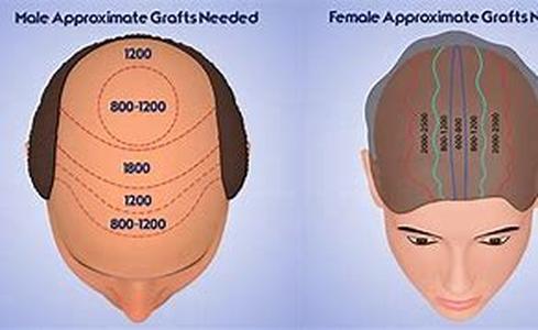 Hair Restoration Surgery Costs