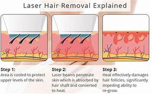 Permanent Hair Removal Treatment