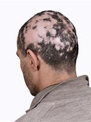Hair Loss Best Solution