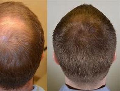 Propecia: Hair Loss, male baldness treatment