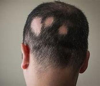 Hair Loss Basic Understanding