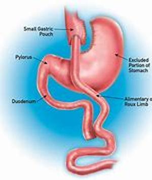 Hair Loss of the Bariatric or Gastric Bypass Patient