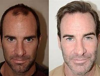 Hair Cloning Research for Hair Transplant Procedures