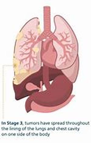 Mesothelioma - Catch It Early To Avoid Big Trouble