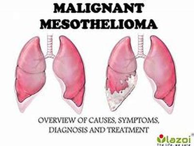 Mesothelioma Advice - Questions And Answers