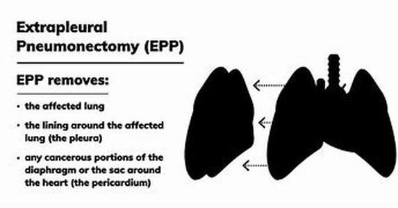 Mesothelioma Prognosis  The science of recovering lives
