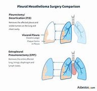 Mesothelioma Lawsuits
