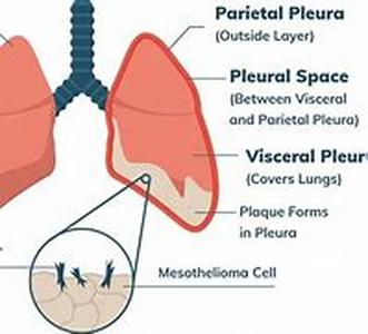 Mesothelioma, a Cancer You Shouldn't Have Had to Deal With