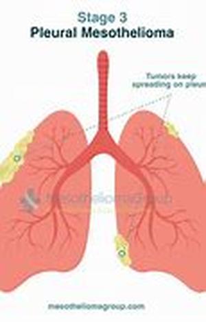 Mesothelioma Statistics - An Eye-opener