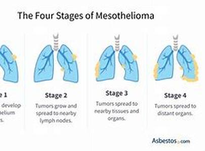 Mesothelioma - History, Hazards and Dietary Advice