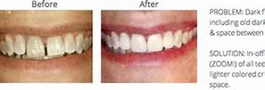 Phentermine a Miraculous Diet Pill