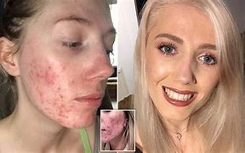 Acne Treatments for Teenagers