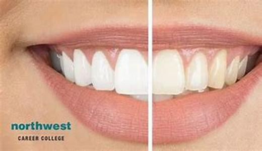 Teeth Whitening Options