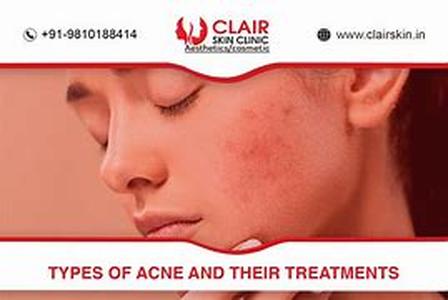 Acne Treatment- Regime For Moderate To Severely Moderate Acne