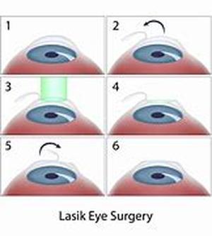 Lasik Eye Center