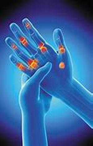 Arthritis Basics