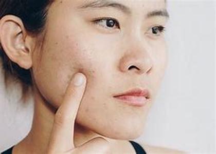 Adults Don't Get Acne