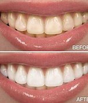 Teeth Whitening kits