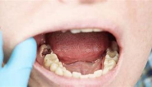 Bad Breath Toothpaste  Are you suffering from bad breath