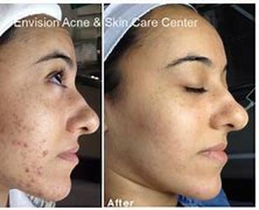 Acne Home Cures
