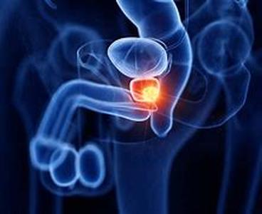 Prostate Cancer Information  Males Take Notice