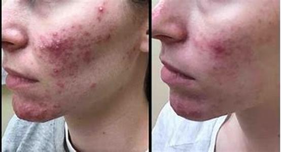 Acne Medication Potential Side Effects