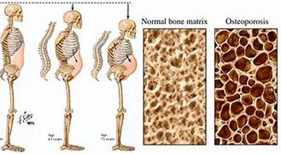 Body Wrapping And Obesity