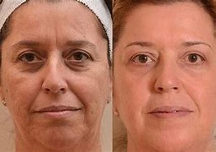 Preparing for a Laser Teeth Whitening Procedure
